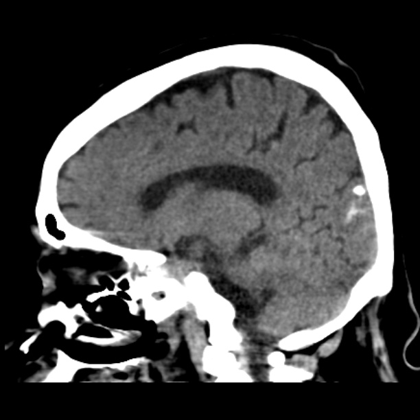Brain cortical laminar necrosis (Radiopaedia 25822-25971 non-contrast 22).jpg