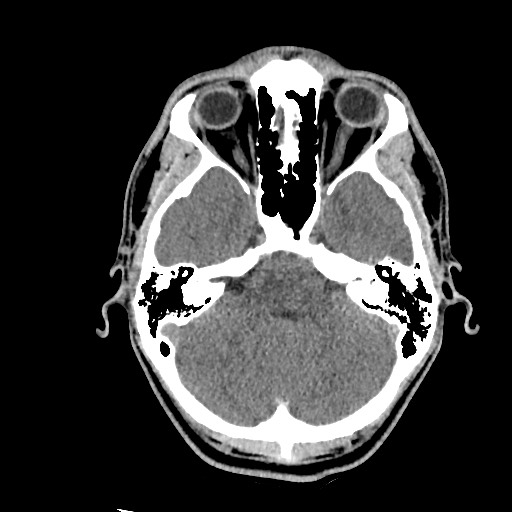 Brain death (Radiopaedia 78597-91360 Axial non-contrast 19).jpg