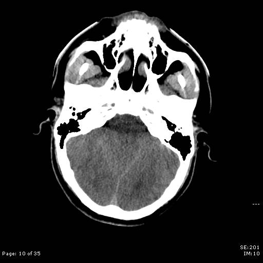 File:Brain death after motor vehicle collision (Radiopaedia 88470-105114 Axial non-contrast 10).jpg