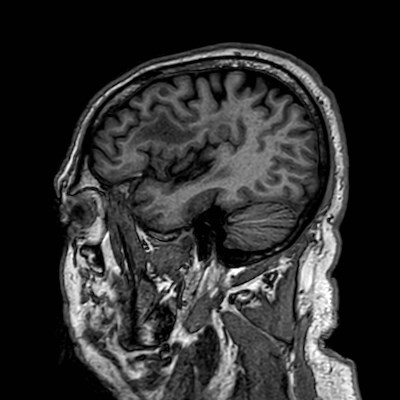 Brain metastases from lung cancer (Radiopaedia 83839-99028 Sagittal T1 25).jpg