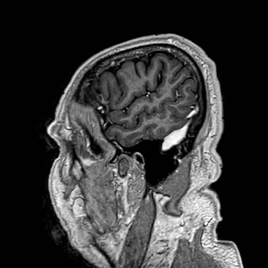 Brain metastases from lung cancer (Radiopaedia 83839-99028 Sagittal T1 C+ 6).jpg