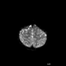 File:Brainstem ganglioglioma (Radiopaedia 10763-11224 Axial DWI 3).jpg