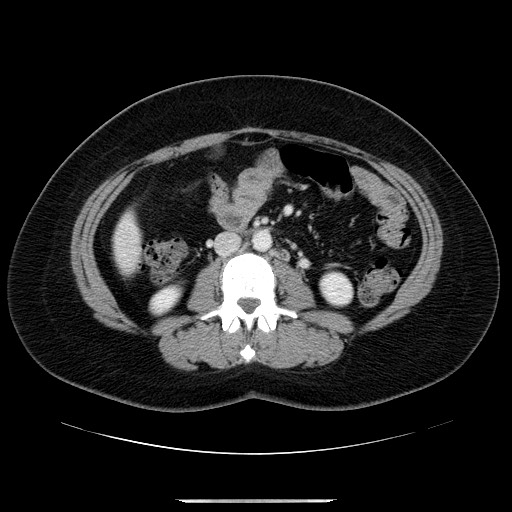 File:Breast cancer pseudocirrhosis after chemotherapy (Radiopaedia 65407-74456 A 46).jpg