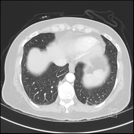Breast metastases from renal cell cancer (Radiopaedia 79220-92225 Axial lung window 68).jpg