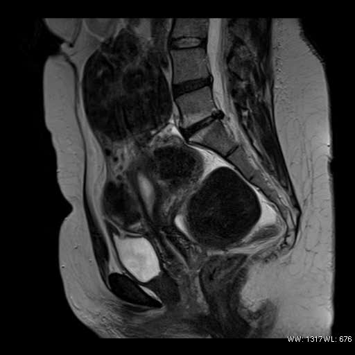 File:Broad ligament fibroid (Radiopaedia 49135-54241 Sagittal T2 14).jpg