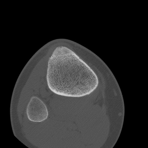 Brodie abscess of the tibia (Radiopaedia 58984-66250 Axial bone window 81).jpg