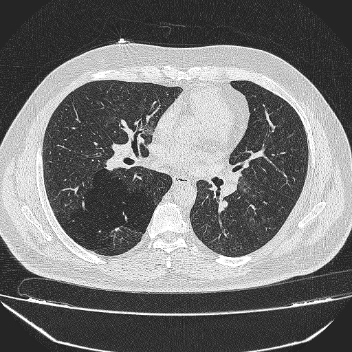 File:Bronchial atresia (Radiopaedia 58271-65417 Axial lung window 25).jpg