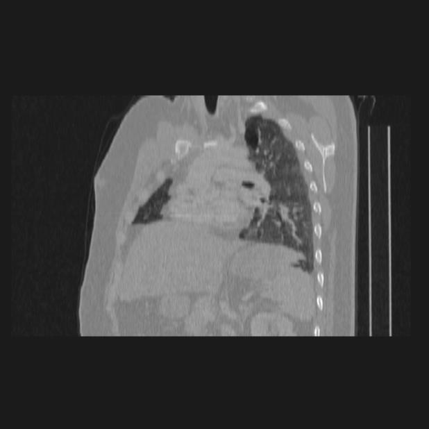 Bronchial atresia (Radiopaedia 60685-68439 Sagittal lung window 52).jpg