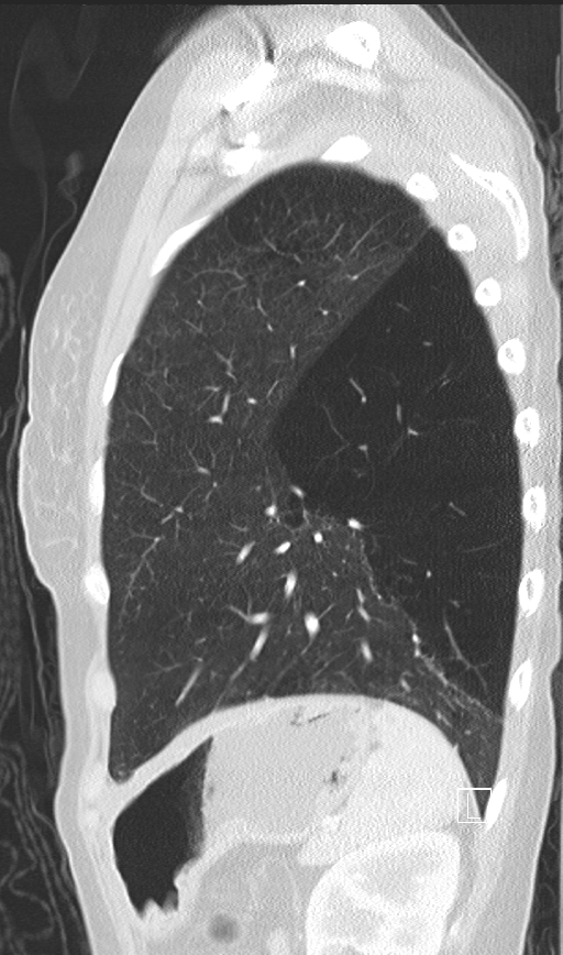 Bronchial atresia (Radiopaedia 73677-84470 Sagittal lung window 43).jpg