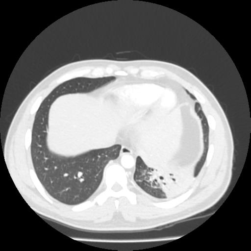 Bronchial carcinoid (Radiopaedia 80013-93291 Axial lung window 100).jpg