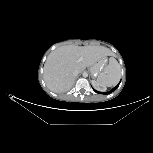 Bronchial carcinoid tumor (Radiopaedia 57187-64090 A 71).jpg