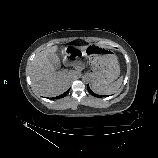 Bronchial carcinoid tumor (Radiopaedia 78272-90870 Axial non-contrast 102).jpg
