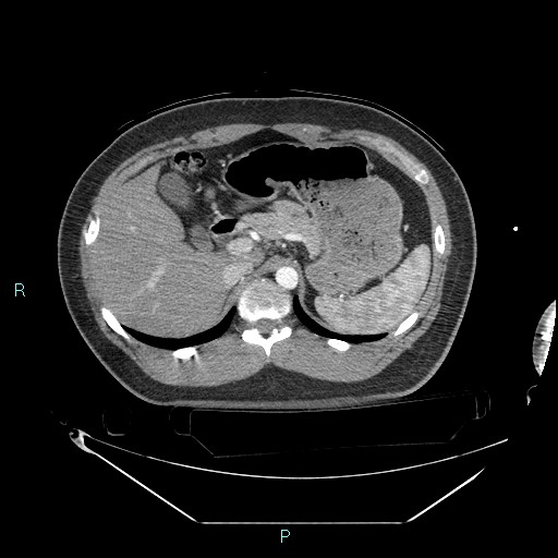 Bronchial carcinoid tumor (Radiopaedia 78272-90870 B 121).jpg