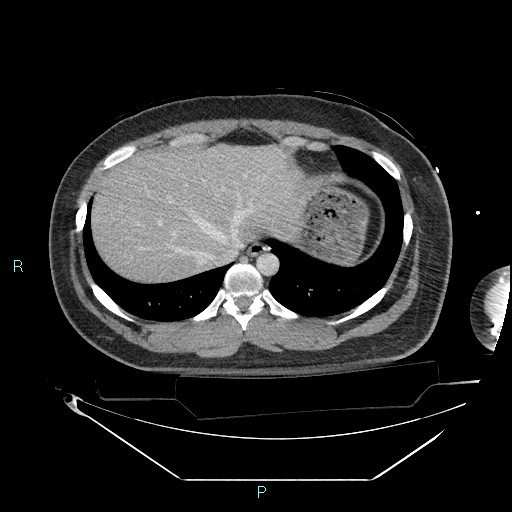 File:Bronchial carcinoid tumor (Radiopaedia 78272-90870 C 100).jpg