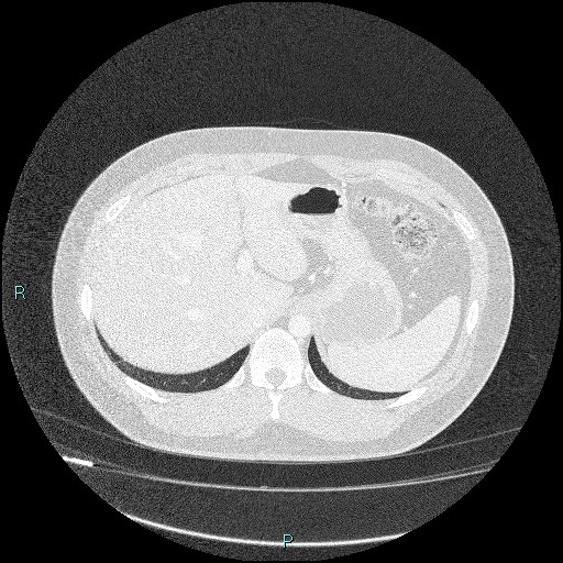 Bronchial carcinoid tumor (Radiopaedia 78272-90875 Axial lung window 51).jpg