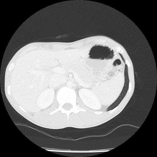 Bronchial carcinoid tumor causing right lower lobe collapse (Radiopaedia 83495-98594 Axial lung window 56).jpg
