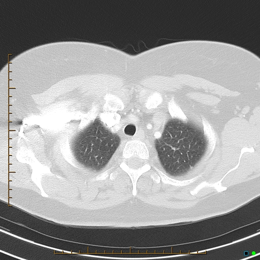 Bronchial diverticula (Radiopaedia 79512-92675 Axial lung window 8).jpg