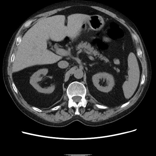 Bronchial stenosis - lung transplant (Radiopaedia 73133-83848 Axial non-contrast 63).jpg