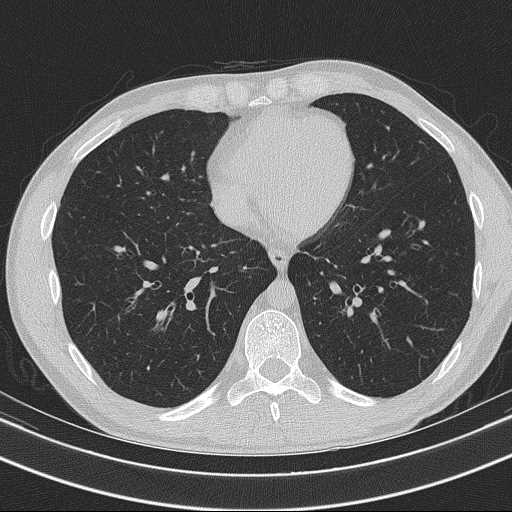 Bronchocele (Radiopaedia 60676-68429 Axial lung window 49).jpg