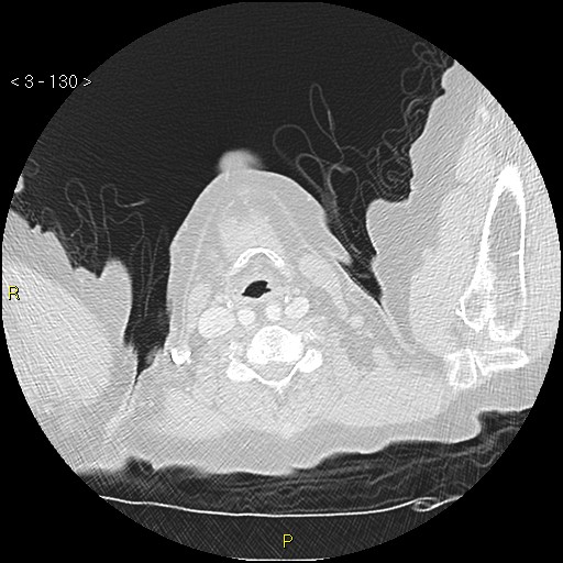 Bronchogenic carcinoma as an incidental finding (Radiopaedia 16453-16130 Axial lung window 130).jpg