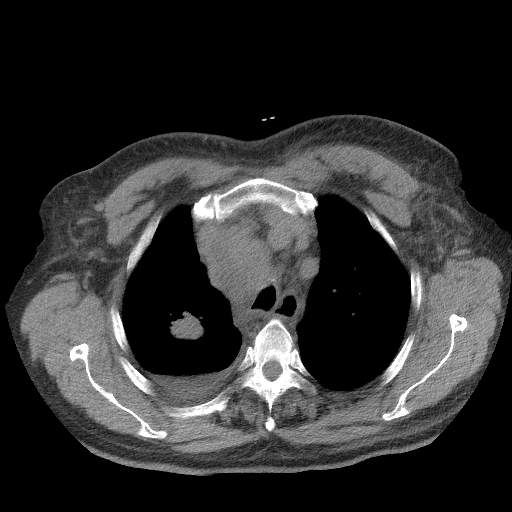 Bronchogenic carcinoma with metastatic lymphadenopathy (Radiopaedia 37671-39569 Axial non-contrast 14).jpg