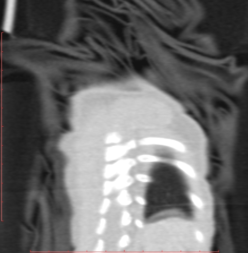Bronchogenic cyst (Radiopaedia 78599-91409 Coronal lung window 211).jpg