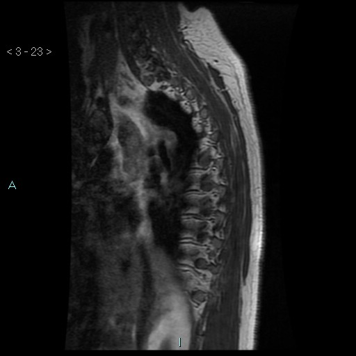 File:Bronchogenic cyst - posterior mediastinal (Radiopaedia 43885-47365 Sagittal T1 23).jpg