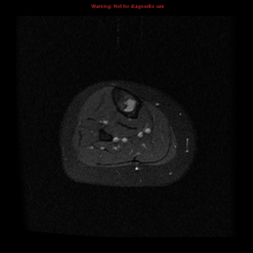 File:Brown tumor (Radiopaedia 12318-12597 Axial T1 C+ fat sat 30).jpg