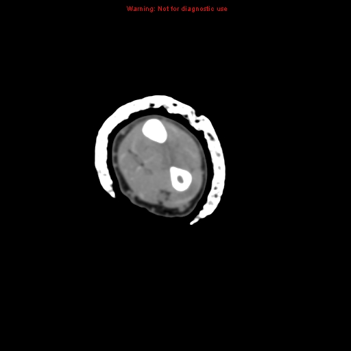 File:Brown tumor (Radiopaedia 12460-12694 Axial non-contrast 80).jpg