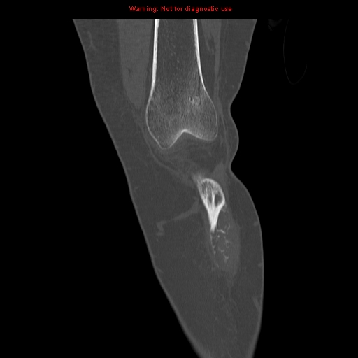 File:Brown tumors (Radiopaedia 9666-10291 Coronal bone window 5).jpg