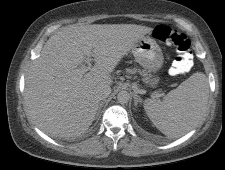File:Brown tumors compressing the spinal cord (Radiopaedia 68442-77988 Axial non-contrast 73).jpg