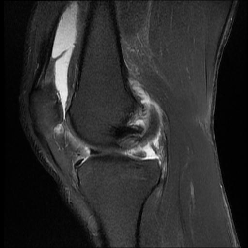 File:Bucket handle tear - medial meniscus (Radiopaedia 69245-79026 Sagittal PD fat sat 11).jpg
