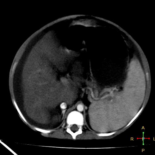 File:Budd-Chiari syndrome (Radiopaedia 23072-23103 C+ arterial phase 9).jpg