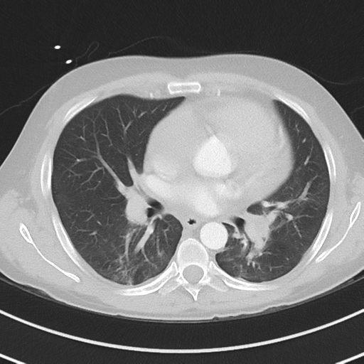 Burkitt lymphoma (Radiopaedia 34686-36121 Axial lung window 26).png