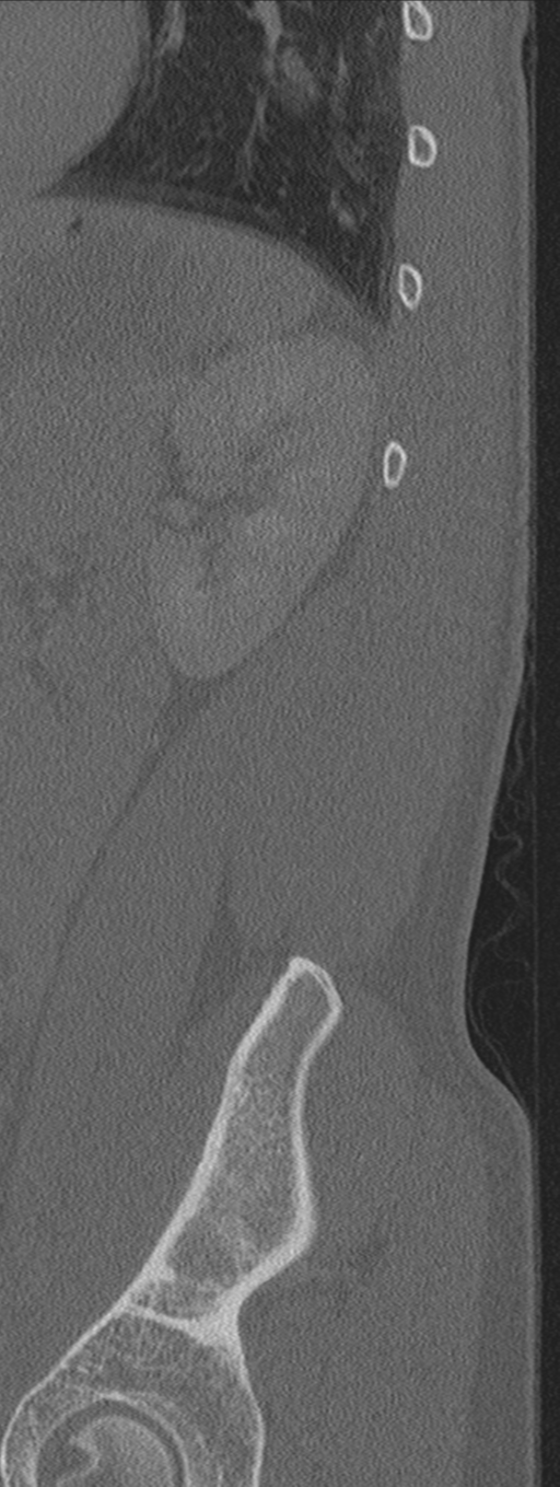 Burst fracture - T12 with conus compression (Radiopaedia 56825-63647 Sagittal bone window 4).png