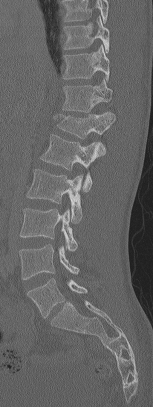 Burst fracture - T12 with conus compression (Radiopaedia 56825-63647 Sagittal bone window 51).png