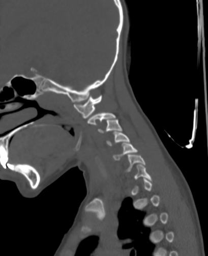 Butterfly vertebra (Radiopaedia 77903-90209 Sagittal bone window 12).jpg