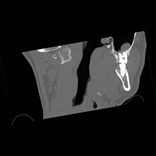 File:C1-C2 "subluxation" - normal cervical anatomy at maximum head rotation (Radiopaedia 42483-45607 Coronal non-contrast 5).jpg