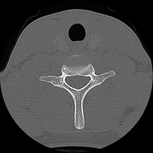 File:C5 facet fracture (Radiopaedia 58374-65499 Axial bone window 69).jpg