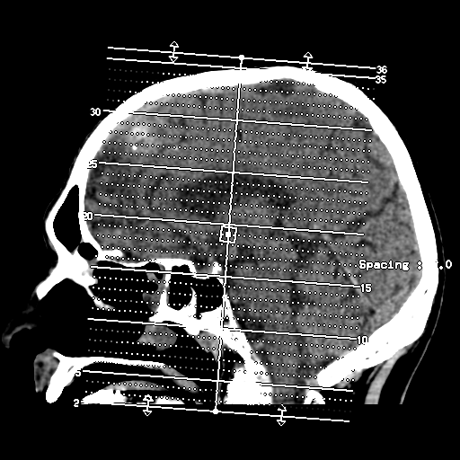 File:CNS lymphoma (Radiopaedia 36983-38639 Axial non-contrast 1).png