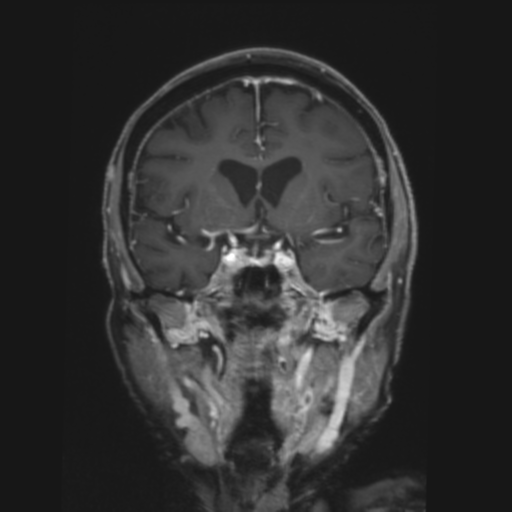 CNS lymphoma with steroid response (Radiopaedia 37980-39921 Coronal T1 C+ 17).png