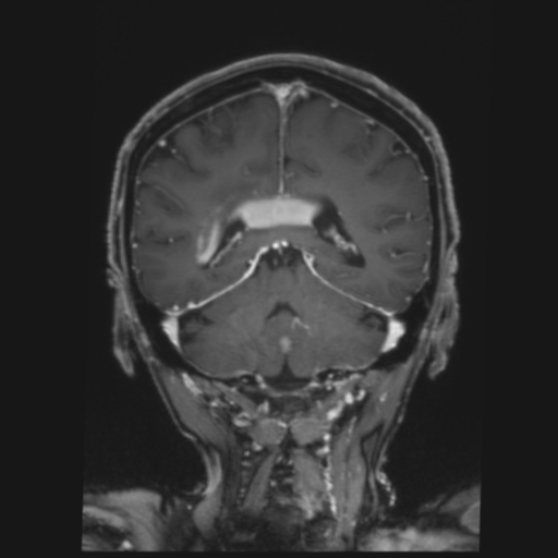 CNS lymphoma with steroid response (Radiopaedia 37980-39921 Coronal T1 C+ 32).png