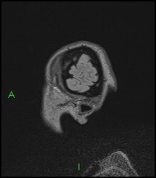 CNS manifestations of NF1 - optic pathway glioma, neurofibroma, dural ectasia (Radiopaedia 37874-39805 Sagittal FLAIR 13).jpg