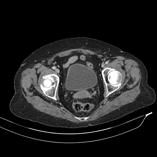 Calcified adrenal glands and Spigelian hernia (Radiopaedia 49741-54988 A 221).jpg