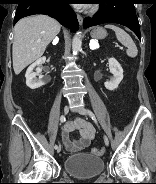 Calcified adrenal glands and Spigelian hernia (Radiopaedia 49741-54988 B 63).jpg