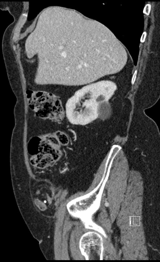 Calcified adrenal glands and Spigelian hernia (Radiopaedia 49741-54988 C 125).jpg