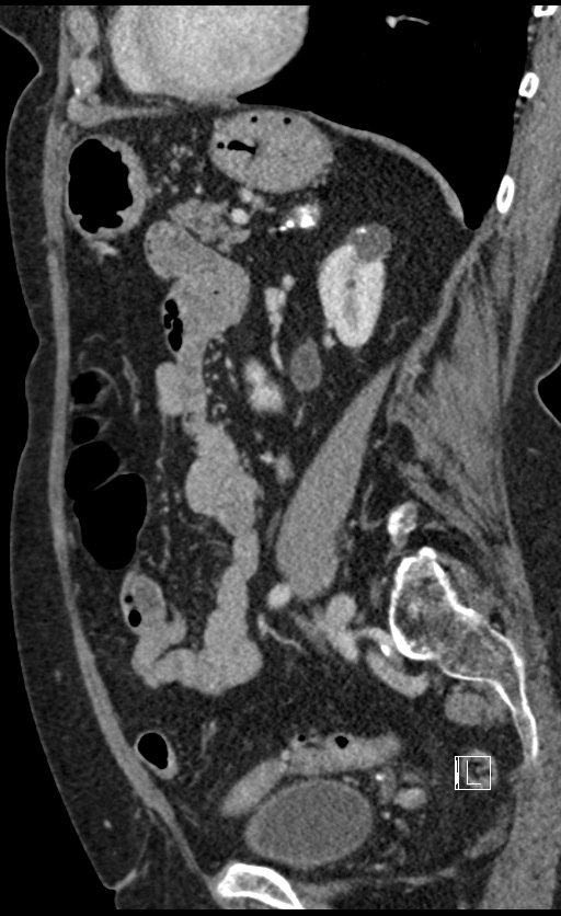 Calcified adrenal glands and Spigelian hernia (Radiopaedia 49741-54988 C 58).jpg