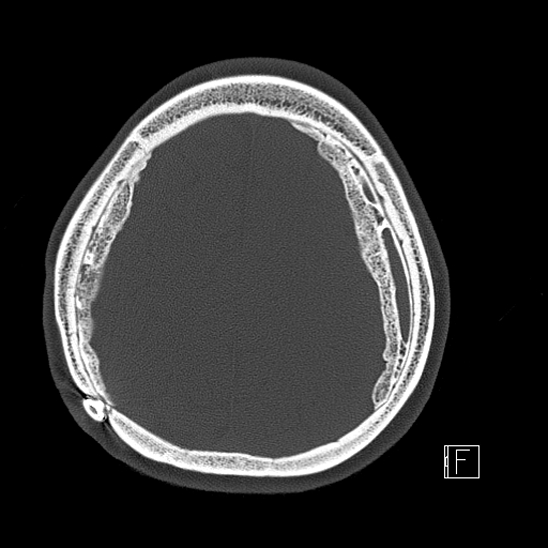 Calcified chronic subdural hematoma (Radiopaedia 77374-89492 Axial bone window 102).jpg