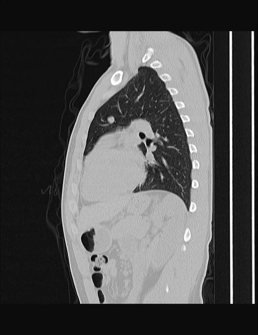 Calcifying pulmonary metastases (Radiopaedia 33359-34396 Sagittal lung window 25).jpg