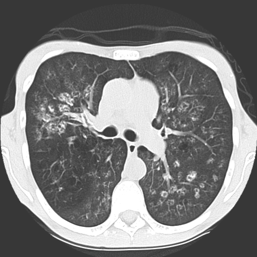 File:Calciphylaxis and metastatic pulmonary calcification (Radiopaedia 10887-11317 Axial lung window 17).jpg